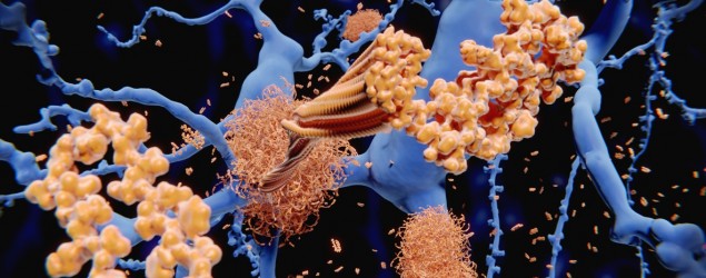 Alzheimer’s disease: the amyloid-beta peptide accumulates to amyloid fibrils that build up dense amyloid plaques.