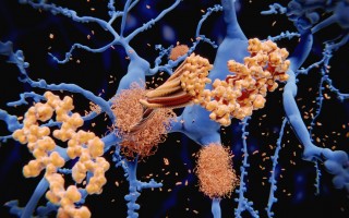 Alzheimer’s disease: the amyloid-beta peptide accumulates to amyloid fibrils that build up dense amyloid plaques.